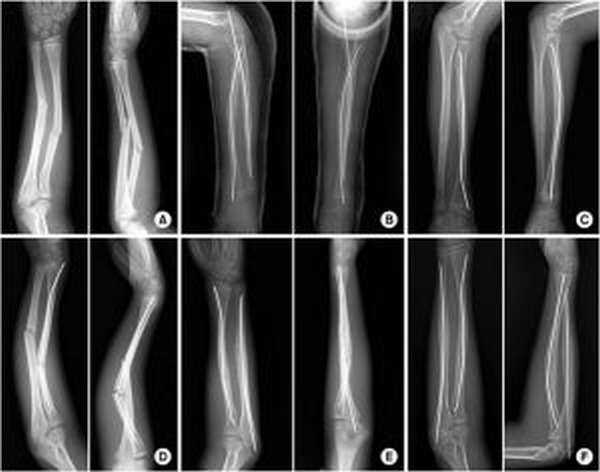 Локтевая и лучевая кости на рентгеновском снимке
